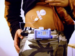 Die Insulinpumpe soll in jeder Situation bequem und sicher getragen werden k�nnen. Daf�r gibt es spezielle Tragesysteme, mit denen die Pumpe z.B. am G�rtel befestigt werden kann.